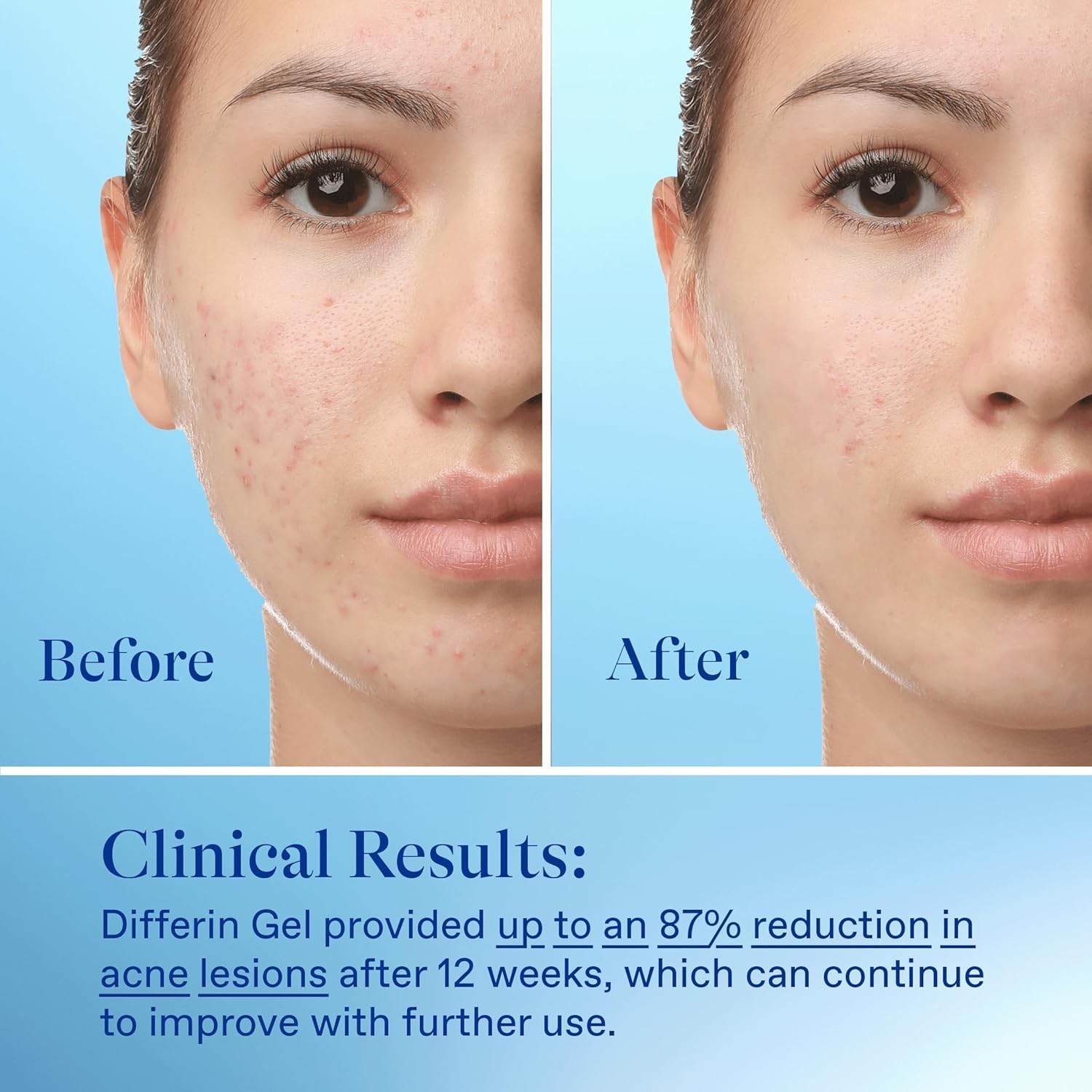 hormonal acne