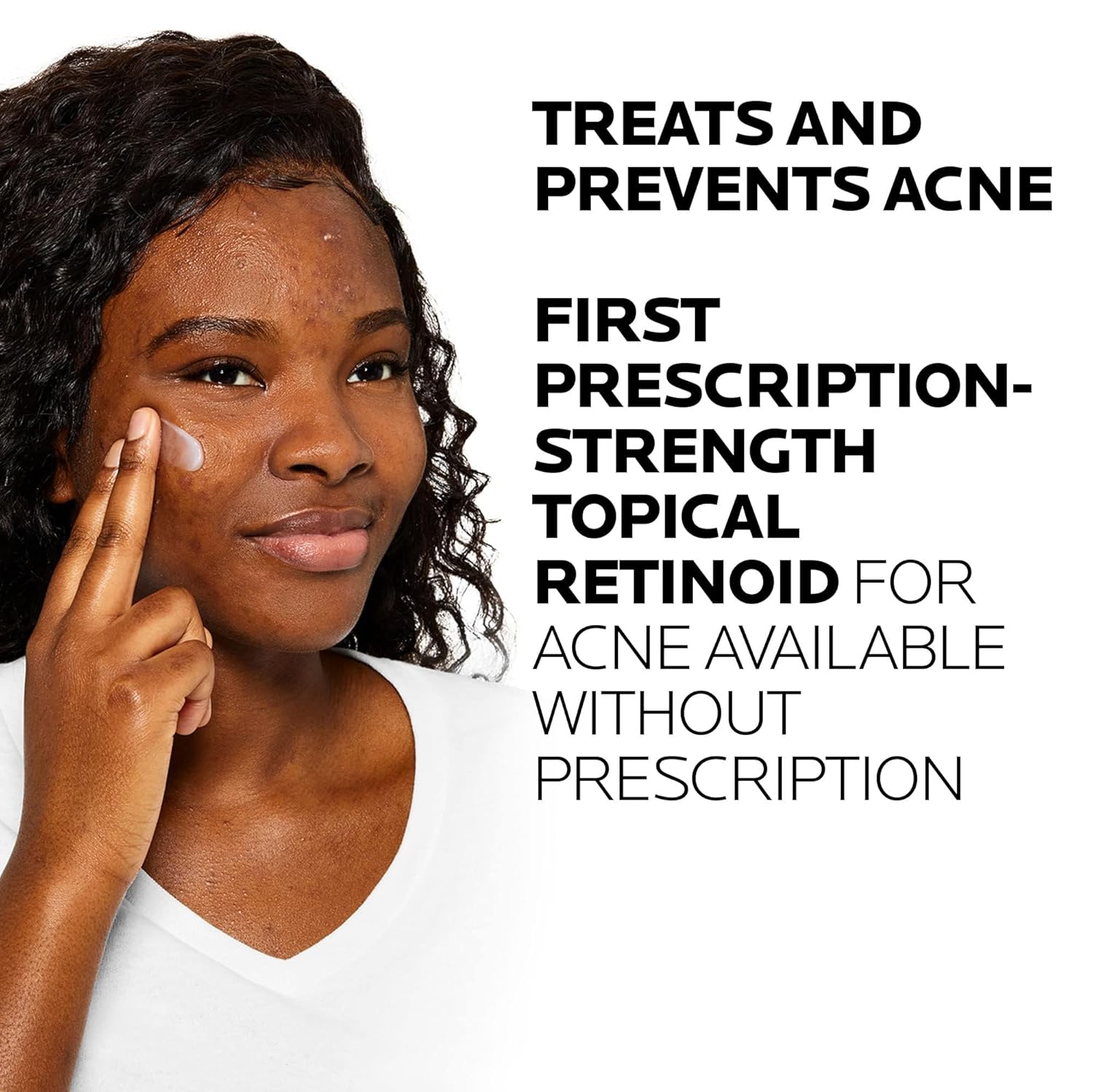 hormonal acne